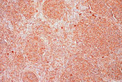 опухоль яичников