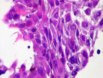 Виды рака влагалища