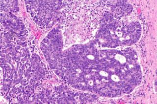 Типы рака влагалища: аденокарцинома