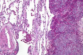 Редкие виды рака влагалища