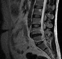 лечение позвоночной грыжи без операции